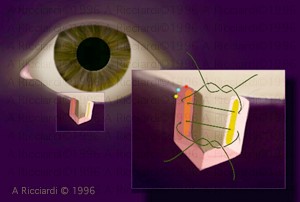 Suture pattern